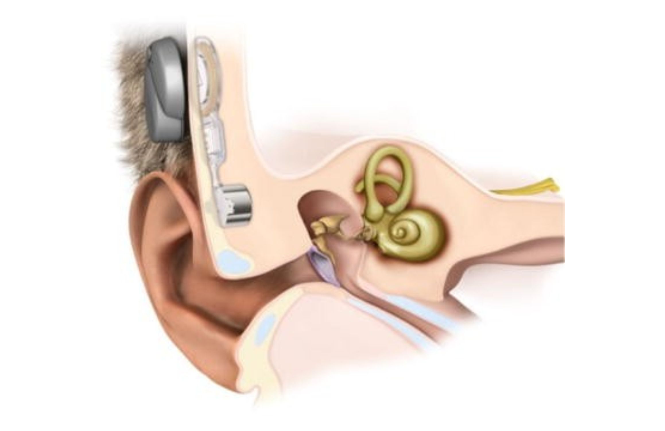 Bone Conduction Implants